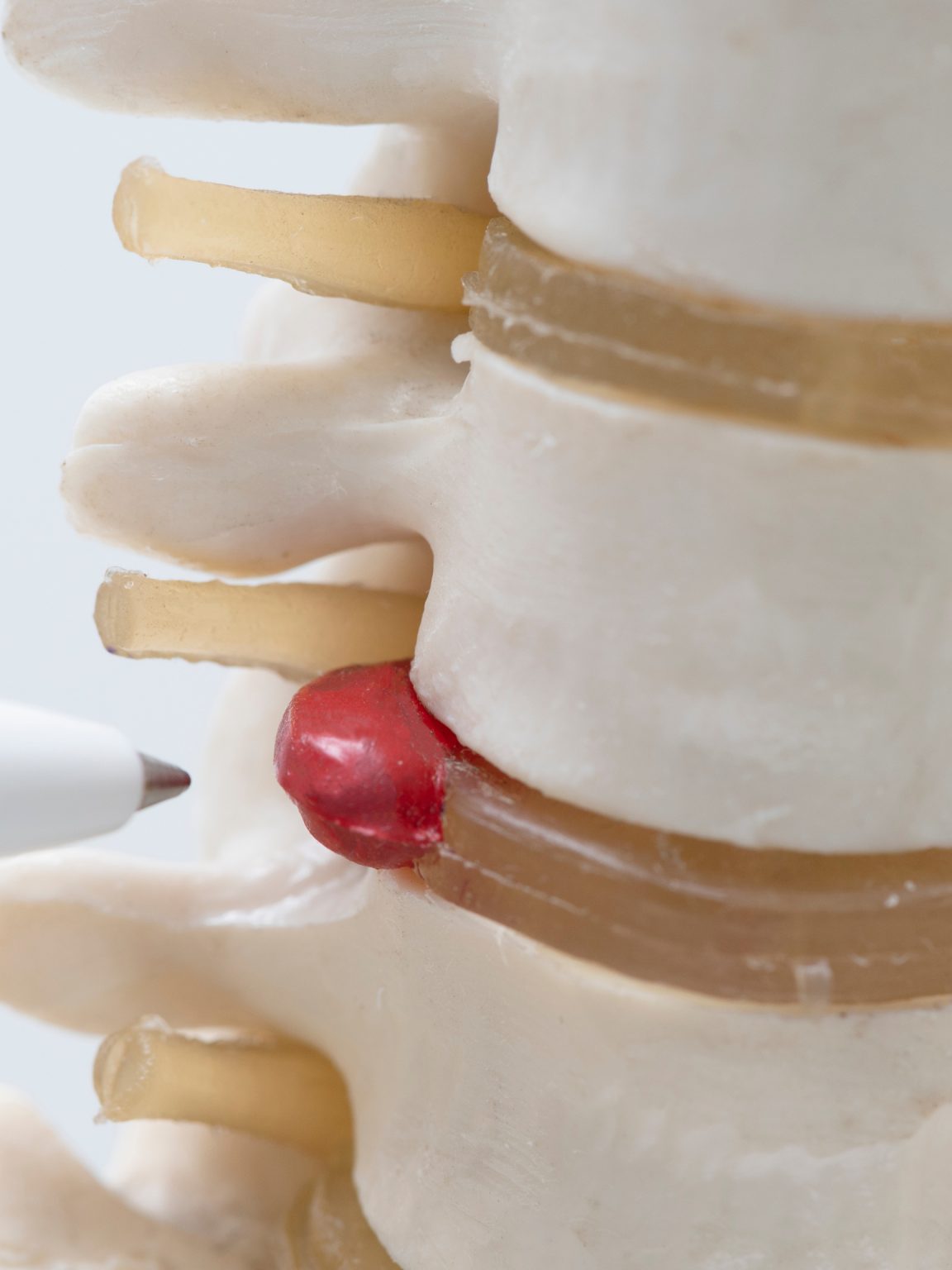 Herniated Disc in Central Oregon Advanced Pain Solutions